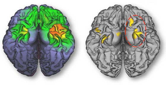 brain_radiation_cell_phone