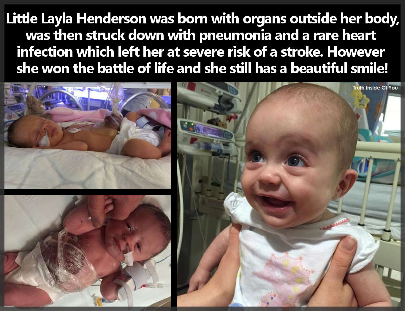 Layla Henderson was born with organs outside her body