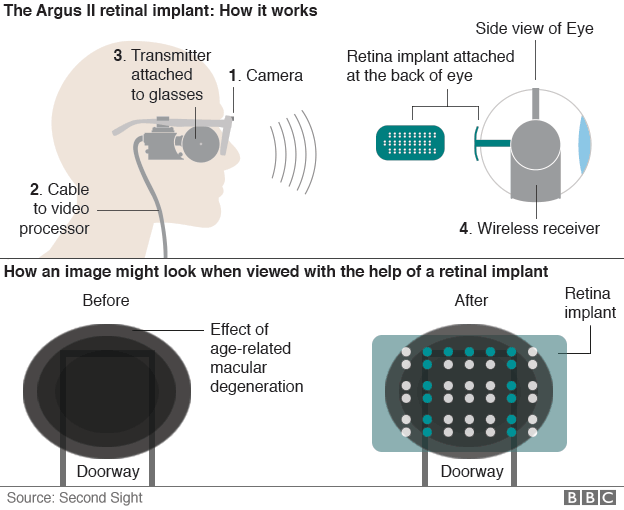 How the Argus II retinal implant operates.