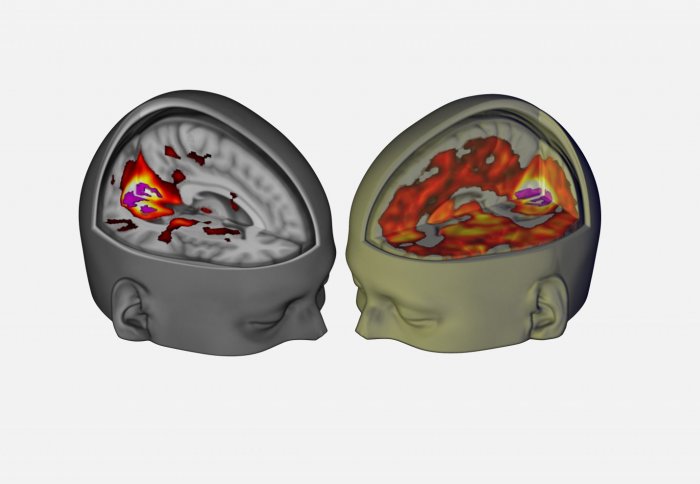 brain on placebo or on LSD