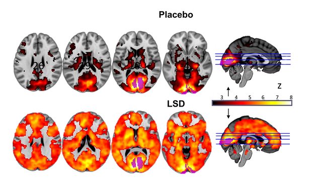 brain on placebo or on LSD