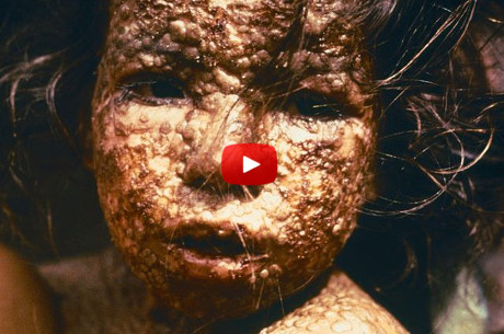 10-deadliest-diseases-human-history