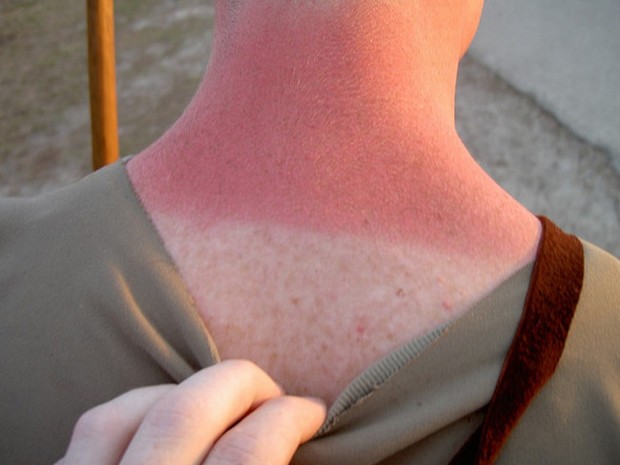 Stop going out in the sun without sunblock.