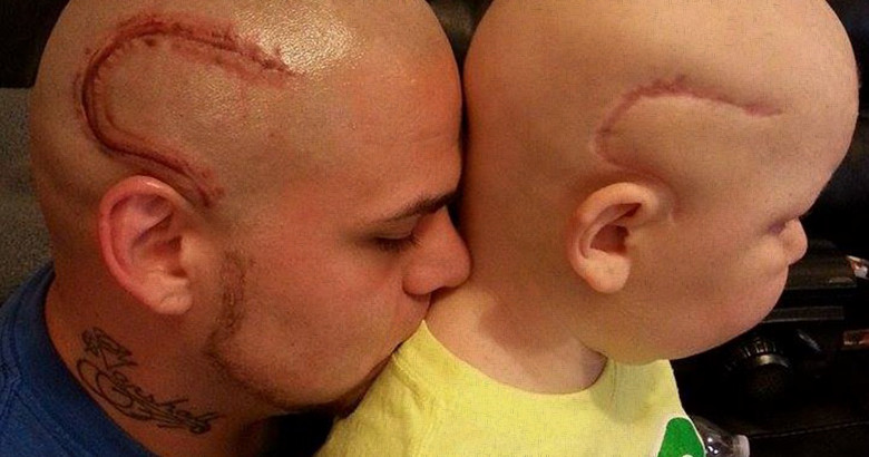 Supportive father gets a tattoo to match his brave young son's brain cancer surgery scar