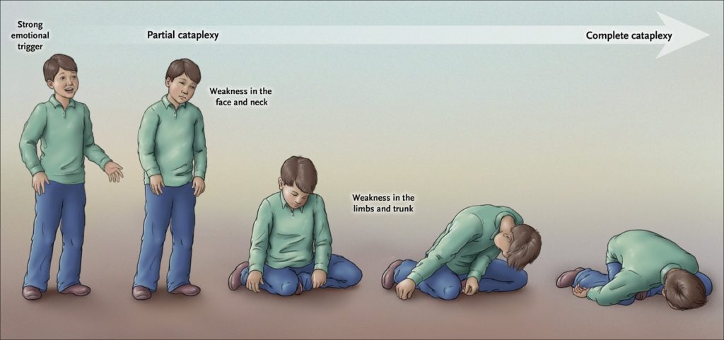 4. Experience cataplexy