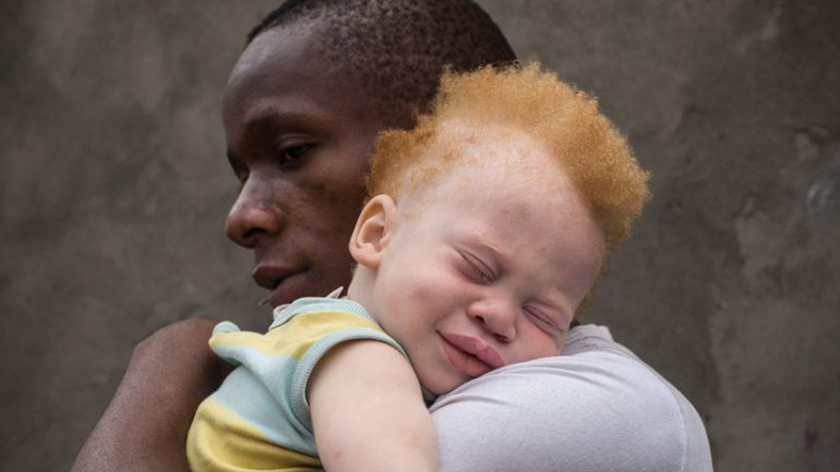 Albinism A unique disorder beyond Race and Ethnicity.