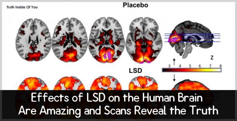 Effects of LSD on the Human Brain Are Amazing and Scans Reveal the Truth