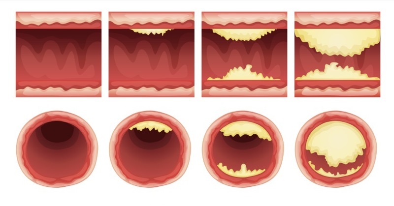 10 Foods That Unclog Arteries Naturally And Protect Against Heart Attack.