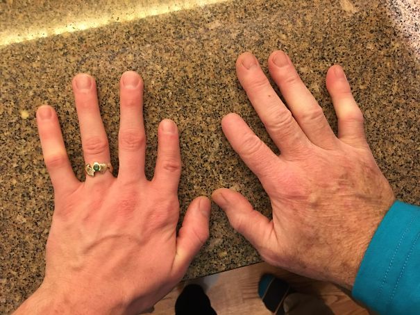 16. My Dad's Index Tip Was Cut Off When He Was 10, My Index Is Shorter Than My Pinky