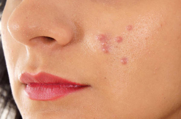 2.-Pimples-and-Health-Problems