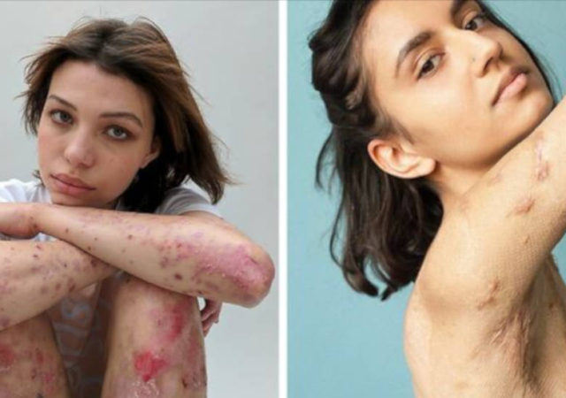 Photographer Captures People And Their Unique Scars In An Inspiring Photo Project