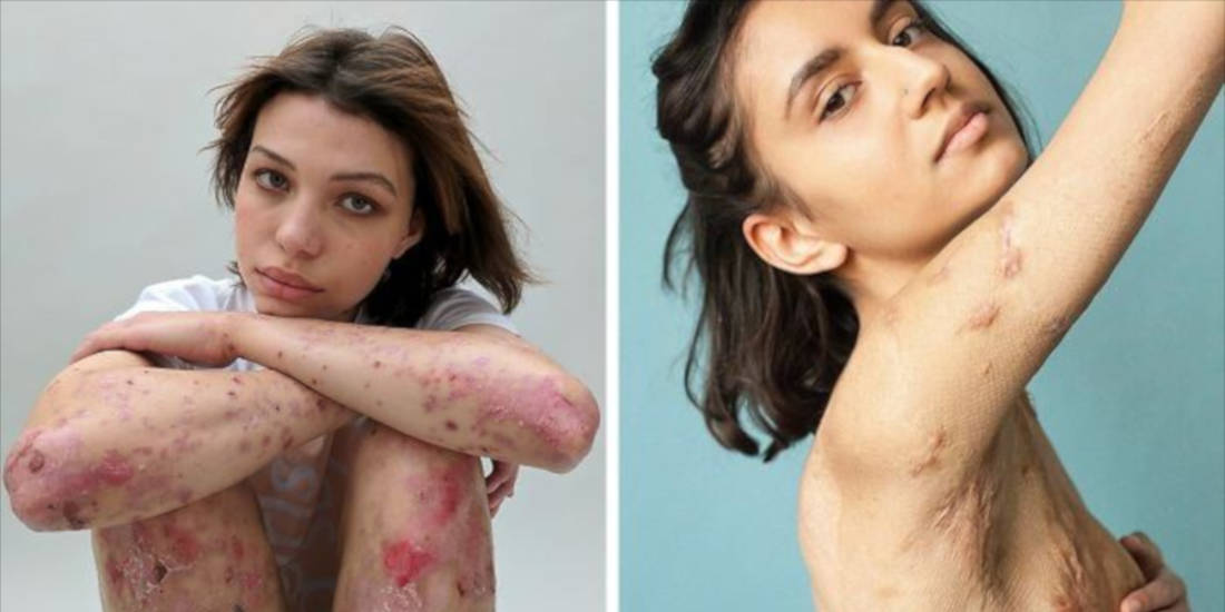Photographer Captures People And Their Unique Scars In An Inspiring Photo Project