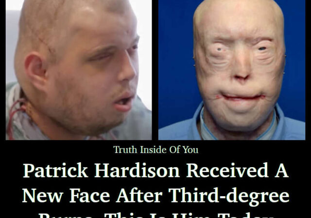 Patrick Hardison received a new face after third-degree burns, this is him today