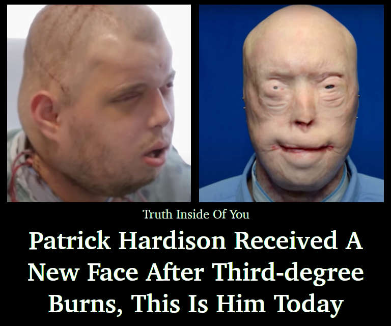 Patrick Hardison received a new face after third-degree burns, this is him today